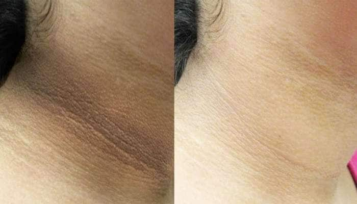 Dark Neck Remedy: ગરદન પર જામેલા મેલને મિનિટોમાં સાફ કરી શકે છે રસોડાની આ 5 વસ્તુઓ