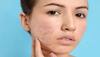 pimples: ખીલના ડાઘથી પરેશાન છો ? તો અઠવાડિયામાં એકવાર દહીંમાં આ વસ્તુ ઉમેરી લગાડો ચહેરા પર