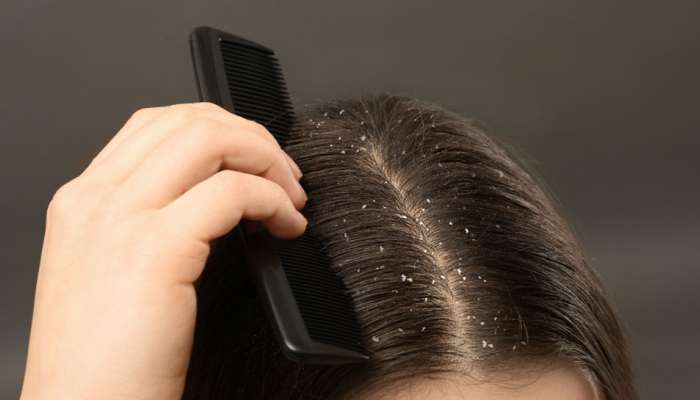 Dandruff: 7 દિવસમાં ડેન્ડ્રફ થઈ જશે સાફ, વાળને સુંદર અને ડેન્ડ્રફ ફ્રી બનાવશે આ ઘરેલુ નુસખા
