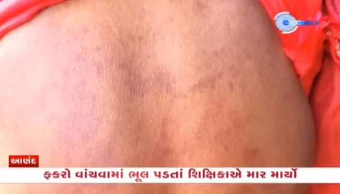 શું ખરેખર તમારું બાળક સ્કૂલમાં સેફ છે? વાંચવામાં ભૂલ પડતા અહીં બાળકીને બરડામાં મુક્કાઓનો વરસાદ!