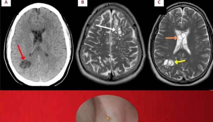 વિચિત્ર મેડિકલ કંડીશન: માણસના મગજમાંથી ટેપવર્મના ઇંડા, માઇગ્રેનની થતી હતી ફરિયાદ