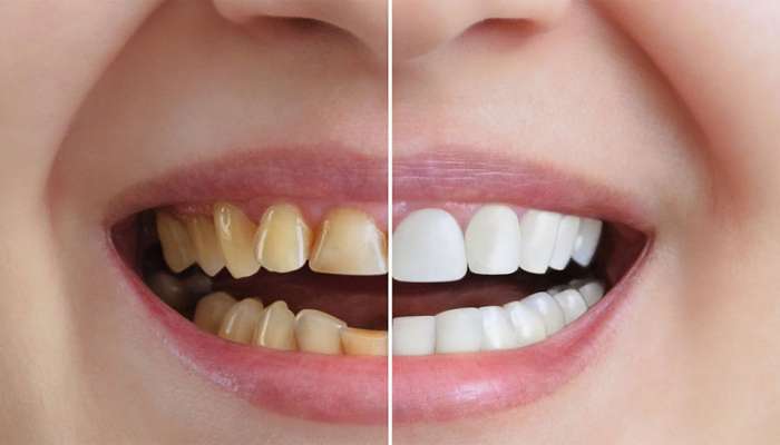 Yellow Teeth: માત્ર 5 રુપિયાના ખર્ચે પીળા પડેલા દાંત થઈ જશે મોતી જેવા સફેદ, ટ્રાય કરો એકવાર