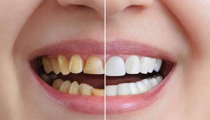 Yellow Teeth: માત્ર 5 રુપિયાના ખર્ચે પીળા દાંત થઈ જશે મોતી જેવા સફેદ, અજમાવો એકવાર