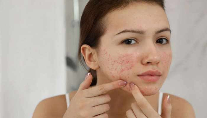 Ayurvedic Remedies: આ આયુર્વેદિક ઉપાયો કરશો તો ચહેરા પરથી તુરંત ગાયબ થશે ખીલ અને ખીલના ડાઘ