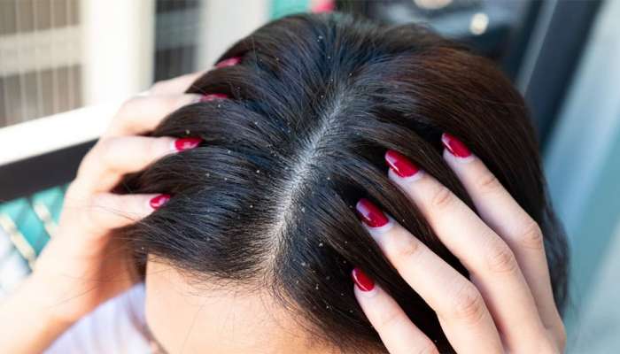 માથાના Dandruff ને 7 દિવસમાં દુર કરી દેશે આ ઘરેલુ નુસખા, અજમાવો 5 માંથી કોઈ એક