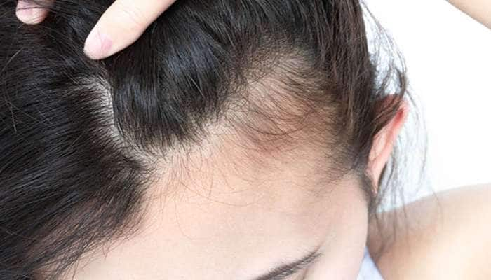 Baby Hair ના કારણે માથામાં દેખાય છે ટાલ ? આ 4 વસ્તુઓ ખાવાથી વધશે બેબી હેરનો ગ્રોથ