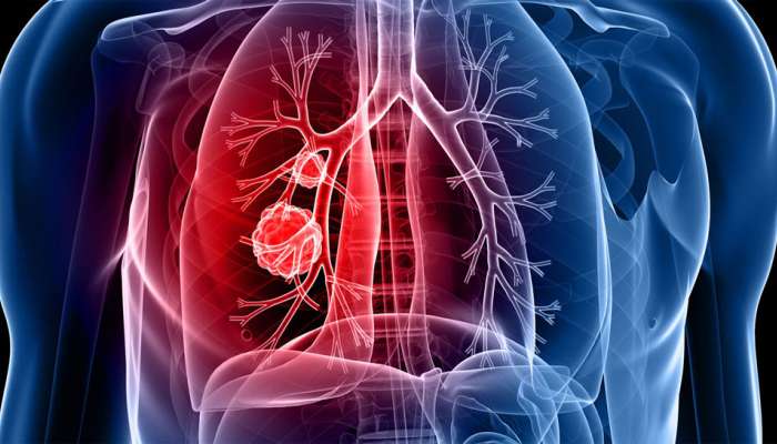 Cancer Symptoms: કેન્સરની શરુઆતમાં શરીરમાં જોવા મળે આ 8 લક્ષણ, આ સાયલન્ટ સંકેતોને ન કરવા ઈન્ગોર