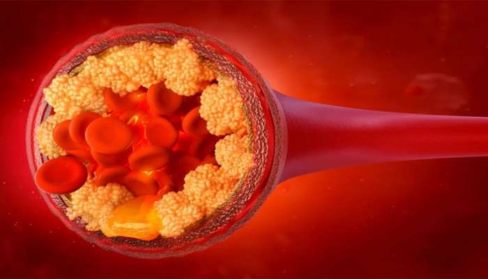 Bad Cholesterol: શરીરમાં વધેલા બેડ કોલેસ્ટ્રોલને તુરંત કંટ્રોલ કરે છે આ 5 વસ્તુઓ, આજથી જ ડાયટમાં કરો સામેલ