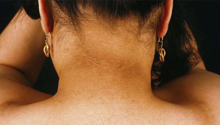 Skin Care: 10 મિનિટમાં જ કાળી ગરદન થઈ જાશે ચહેરા જેવી રુપાળી, ટ્રાય કરો ત્રણમાંથી કોઈ 1 ઘરેલુ નુસખો