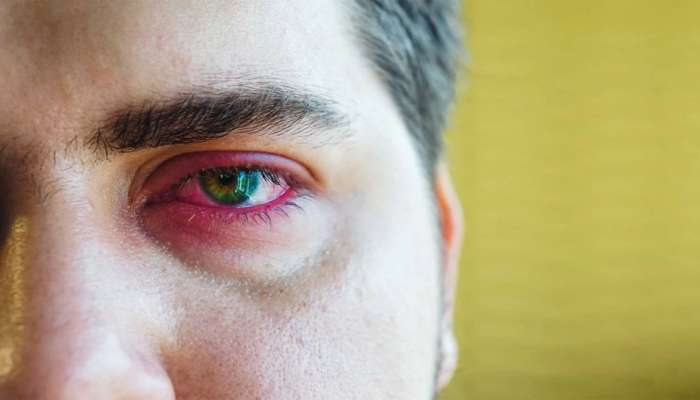Eye Care: હીટવેવમાં આંખોની કાળજી નહીં રાખો તો થઈ જાશો હેરાન, આ રીતે રાખો આંખોનું ધ્યાન 