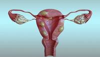 Fibroids: ગર્ભાશયમાં થઈ હોય ગાંઠ તો ખાવા લાગો આ ફળ, સંકોચાવા લાગશે ફાઈબ્રોઈડ જાતે જ
