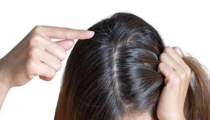 White Hair: આ કારણે ટીનએજમાં વાળ થવા લાગે છે સફેદ, જાણો સફેદ વાળનો ગ્રોથ અટકાવવાના દેશી ઉપાય