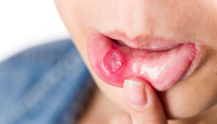 Signs of Oral Cancer: મોઢાના કેન્સરની શરુઆતમાં જોવા મળે આ 8 સંકેતો, 99 ટકા લોકો સામાન્ય સમજી કરે છે ઈગ્નોર