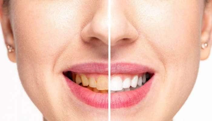 Yellow teeth: 1 ચમચી દહીં પીળા દાંતને કરી દેશે મોતી જેવા સફેદ, જાણો ઉપયોગ કરવાની રીત