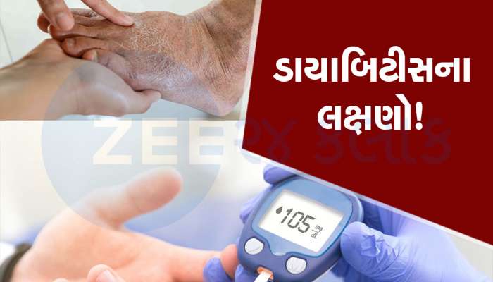 Diabetes Symptoms: પગમાં આવું જોવા મળે તો ચેતી જજો...જાણો ડાયાબિટીસના આ 5 સંકેત વિશે
