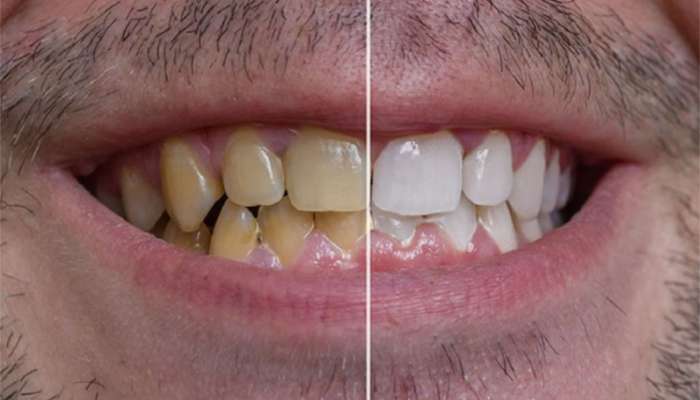 Yellow Teeth: તમારા દાંત પણ પીળા પડી ગયા છે ? તો રોજ ચાવી લેવા આ પાન, 7 દિવસમાં દાંત મોતી જેવા સફેદ થઈ જાશે