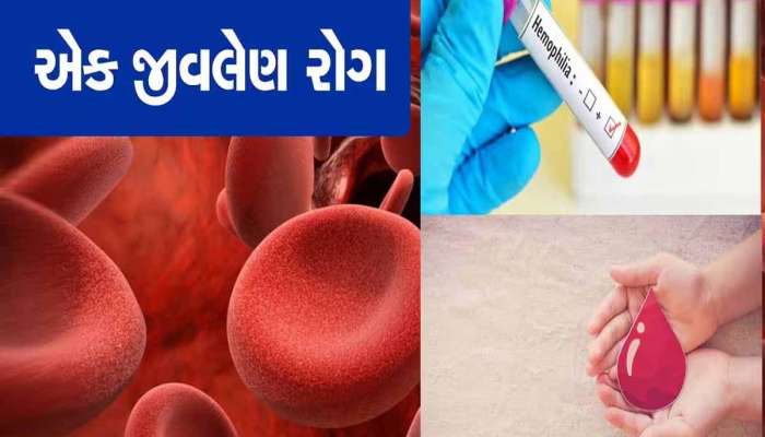  ચાંદીપુરા વાઇરસ વચ્ચે પાદરામાં આ જીવલેણ રોગનો હાહાકાર, 3 કેસ નોંધાતા તંત્રમાં દોડધામ