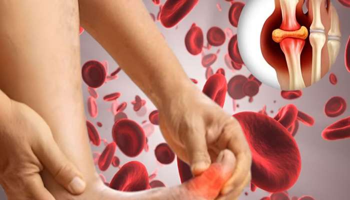 Uric Acid: વધેલા યુરિક એસિડને કંટ્રોલ કરવા અપનાવો આ આયુર્વેદિક ઉપાય, ઝડપથી થશે ફાયદો