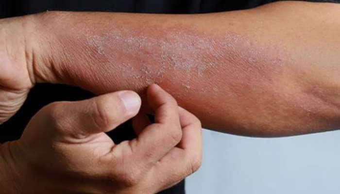 Skin Infection: ચોમાસામાં થતા ત્વચાના રોગથી છુટકારો મેળવવા અપનાવો આ ઘરેલુ નુસખા