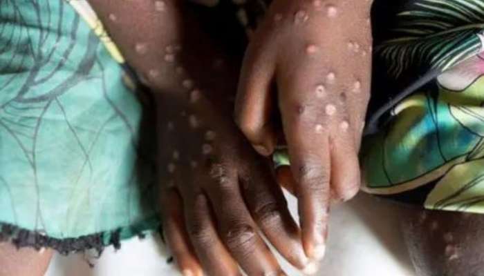 Monkeypox: કોરોનાનો પણ બાપ છે આ બિમારી, પરિવાર પણ પાણીનું નહીં પૂછે, શરીર પરાથી ખદબદી જશે