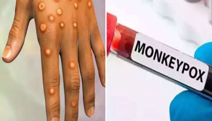 કોરોના કરતા ખતરનાક મહામારી મંકીપોક્સ આખી દુનિયામાં પ્રસર્યું, સરકારે લીધો આ નિર્ણય