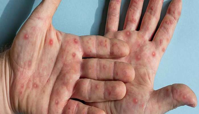 Mpox Outbreak: મંકીપોક્સનો વધ્યો પ્રકોપ, જાણો કેવી રીતે ફેલાય છે આ વાયરસ અને કેવા હોય તેના શરુઆતી લક્ષણ 