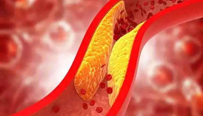 Bad Cholesterol: નસોમાં જામેલા બેડ કોલેસ્ટ્રોલને ઓગાળીને દુર કરી દેશે આ 2 વસ્તુઓ