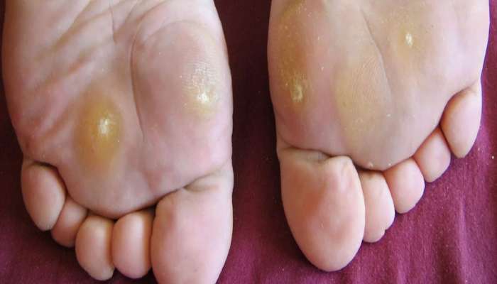Diabetes Symptoms: ડાયાબિટીસનો સંકેત હોય છે પગમાં થતી આ સમસ્યા, જાણો બચવા માટે શું કરવું ?