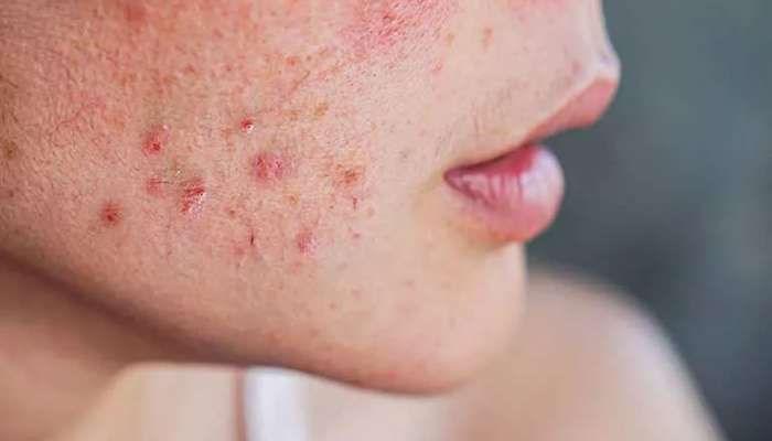 Period pimples: માસિકના 7 દિવસ પહેલા કરી લેશો આ કામ તો ત્વચા પર નહીં નીકળે હોર્મોનલ પિંપલ્સ