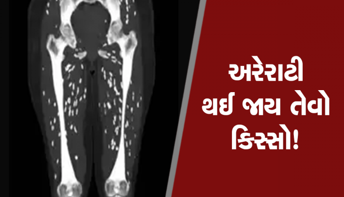 દર્દીના પગનું સિટી સ્કેન જોઈ ચોંકી ગયા ડોક્ટર્સ, પગમાં ફરતા દેખાયા જીવતા કીડા!