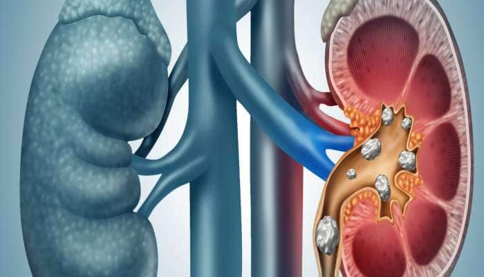 Kidney Stone: કિડનીમાં પથરી વધારે છે આ 5 શાકભાજી, ખાતા હોય તો આજથી કરી દેજો બંધ