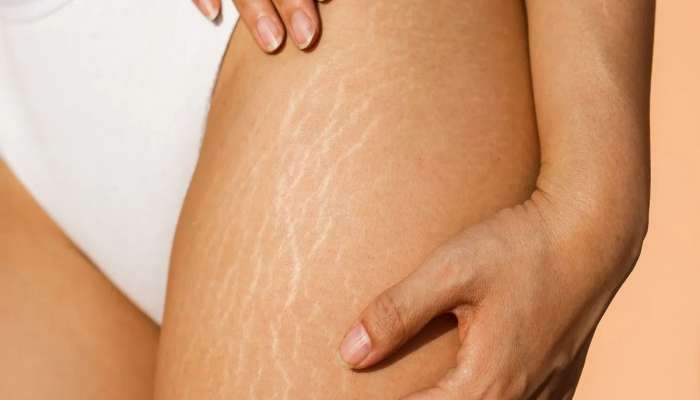 Stretch Marks: સાથળ પર લગાડો ઘરમાં રહેલી આ 4 વસ્તુમાંથી કોઈ 1, સ્ટ્રેચ માર્ક્સ 7 દિવસમાં ગાયબ થશે