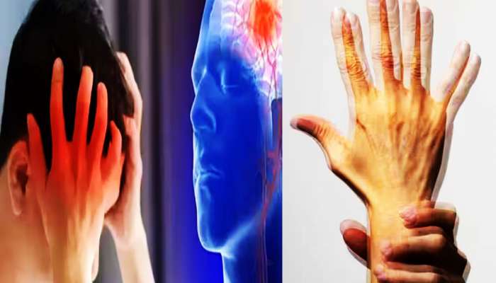 બ્રેઈન સ્ટ્રોકના 7 દિવસ પહેલા દેખાય છે આ 5 સંકેતો, તરત જ કરાવો સારવાર