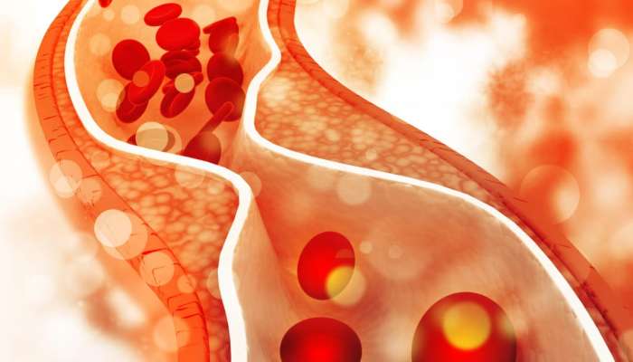 LDL Cholesterol: બેડ કોલેસ્ટ્રોલ ઘટાડવાના રામબાણ ઉપાય, ઘર પર કરો આ 5 વસ્તુ અને જુઓ કમાલ