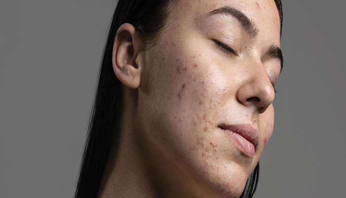 Skin Care: 7 જ દિવસમાં ચહેરા પરના ડાઘ દૂર કરવા હોય તો અપનાવો આ 5 માંથી કોઈ એક નુસખો