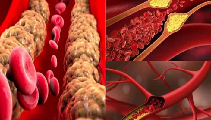 Home Remedies: શરીરમાં જો કોલેસ્ટ્રોલ વધી ગયું હોય તો અપનાવો આ ઘરગથ્થું નુસ્ખા, નસોમાં જામેલી ગંદકી સાફ થઈ જશે