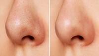 Blackheads: માત્ર 5 મિનિટમાં નાક પરના બ્લેકહેડ્સ થઈ જશે ગાયબ, અપનાવો આ ઘરેલુ ઉપાય