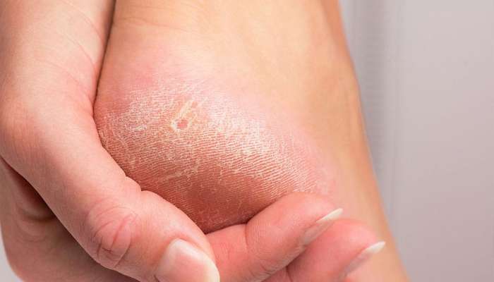 5 ઘરેલુ ઉપાયથી 7 દિવસમાં ફાટેલી એડીની તકલીફ થશે દૂર, આખો શિયાળો નહીં ફાટે એડી