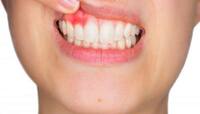 Tooth: દાંતની કેવિટીથી છુટકારો અપાવશે આ ઘરેલુ ઉપાય, સડા અને દુખાવાથી તુરંત મળશે રાહત