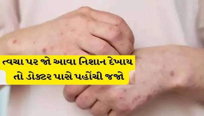 ડાયાબિટીસનો સંકેત હોઈ શકે છે ચામડીની આ સમસ્યા! ઈગ્નોર ના કરતા, બની શકે છે ખતરનાક!