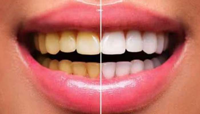 આ ફળની છાલ માત્ર 3 મિનિટમાં બનાવશે મોતી જેવા સફેદ દાંત, દાંત પરથી પીળાશ થશે દૂર