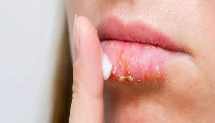Dry Lips: શિયાળામાં હોઠ ફાટે ત્યારે અપનાવો આ 3 નુસખા, ફાટેલા હોઠની તકલીફથી મળશે આરામ