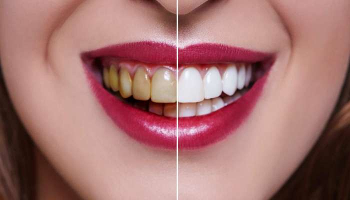 Teeth Whitening Tips: મોતી જેવા સફેદ ચમકતા દાંત માટે અજમાવી જુઓ આ સરળ ઘરેલુ નુસખા