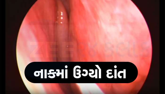 રેરેસ્ટ ઓફ ધ રેર કહેવાય તેવો કેસ! મહિલાના જમણા નાકમાં ઉગી નીકળ્યો દાંત 