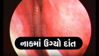 રેરેસ્ટ ઓફ ધ રેર કહેવાય તેવો કેસ! મહિલાના જમણા નાકમાં ઉગી નીકળ્યો દાંત 