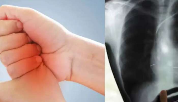 Cancer Symptoms: ફેફસાના કેન્સરના હાથમાં દેખાય છે આ 2 લક્ષણો, જાણો બચવા માટેના ઉપાય