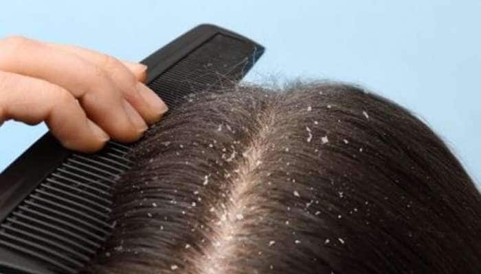 Dandruff solution: શિયાળામાં ડેન્ડ્રફથી છુટકારો મેળવવા માટે 6 અસરકારક ઘરેલું નુસ્ખા