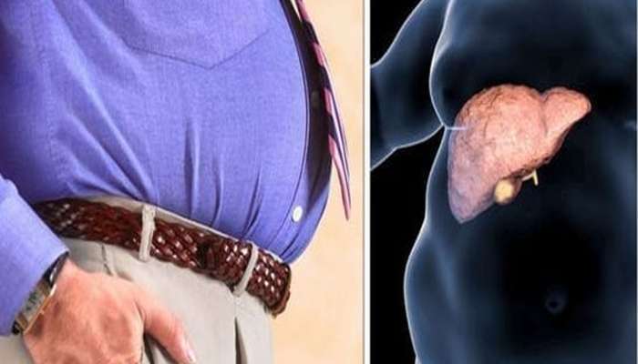 Fatty Liver: પેટની આસપાસ ચરબી વધવાથી વધે છે નોન આલ્કોહોલિક ફેટી લિવરનું જોખમ, જાણી લો બચાવના ઉપાય