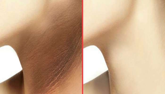 Dark Neck: ગરદનની સ્કિન ચહેરા કરતાં કાળી છે? કોફીમાં આ 2 વસ્તુ મિક્સ કરી લગાડો, ગરદનની કાળી ત્વચા ચહેરા જેવી ગોરી થશે