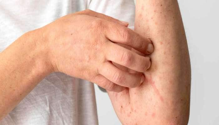 Liver Damage Signs: લીવર ડેમેજ થતું હોય ત્યારે શરીરમાં જોવા મળે છે આ 5 લક્ષણો